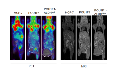 POU1F1 induces cancer stem cell-like traits in breast cancer cells by IL-6/JAK2/ STAT3 activation and enrichment of ALDH – Avila et al.